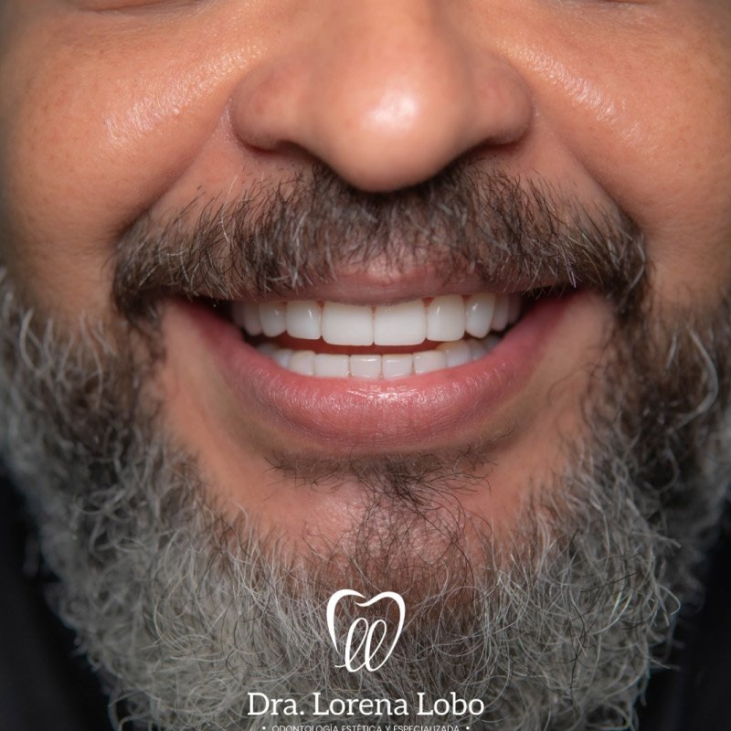 diseño-de-sonrisa-en-puerto-boyaca