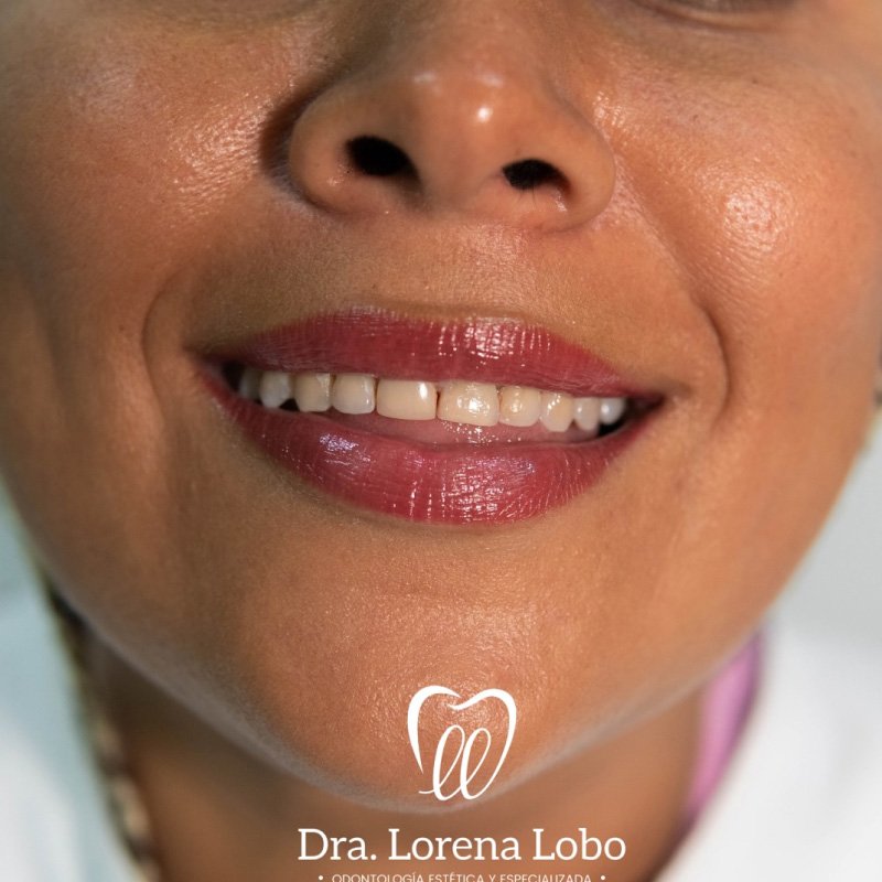 diseño-de-sonrisa-en-puerto-boyaca