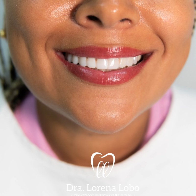 diseño-de-sonrisa-en-puerto-boyaca