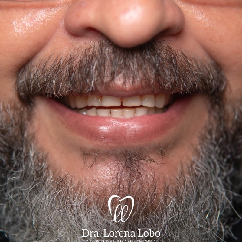 diseño-de-sonrisa-en-puerto-boyaca